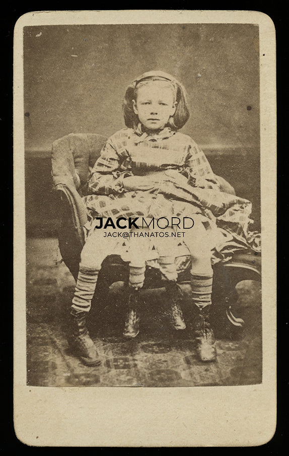 Rare 1800s Photo 4-Legged Girl with Parasitic Twin